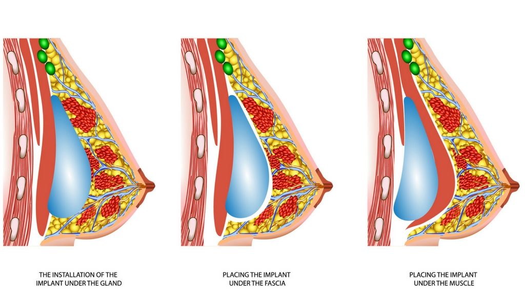 The Perfect Breast Augmentation